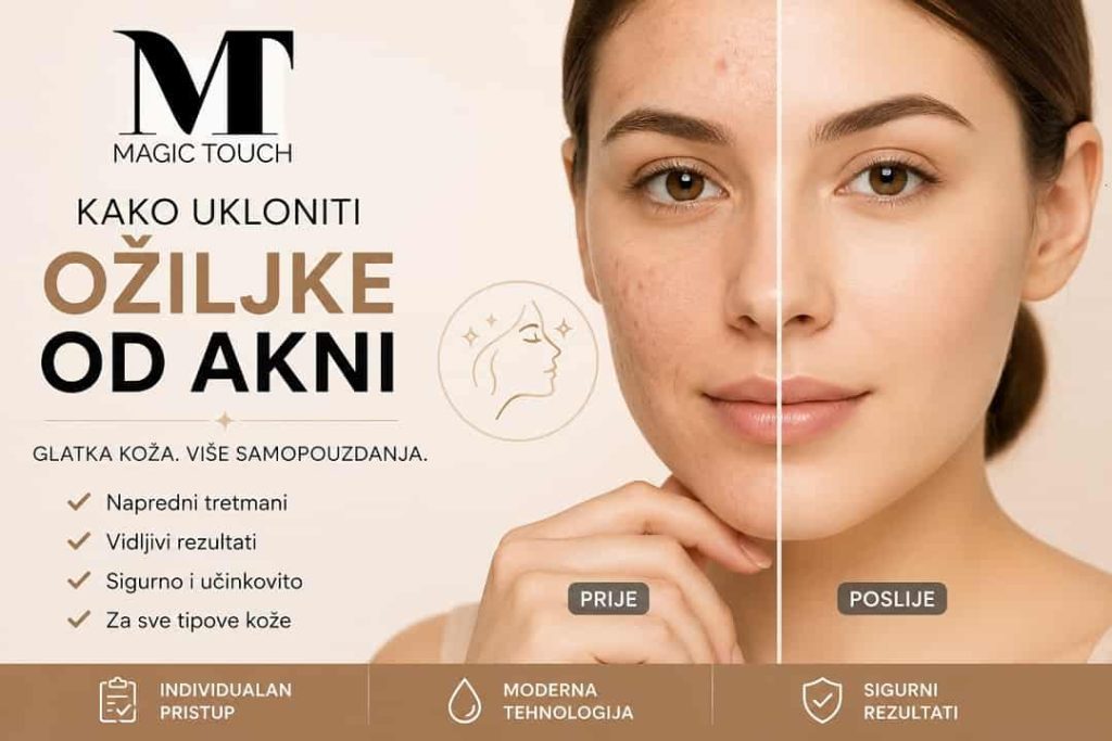 kako ukloniti ožiljke od akni